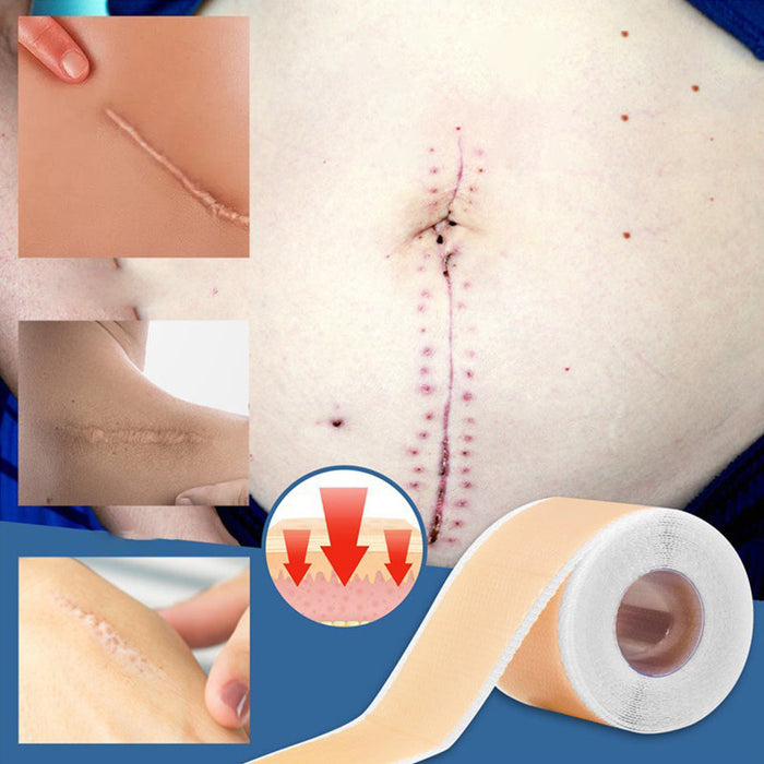 Silicone Wound Decrease Scar Patches