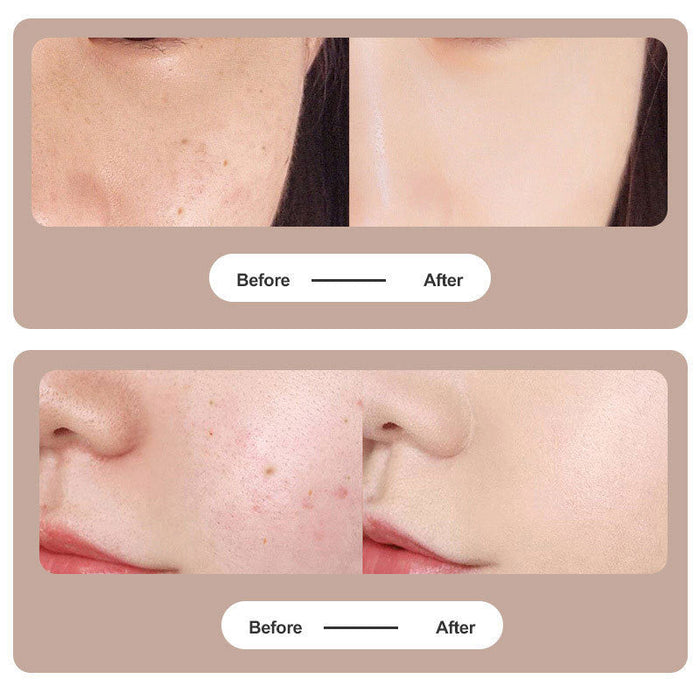 UV LED Mole & Spot Remover Pen
